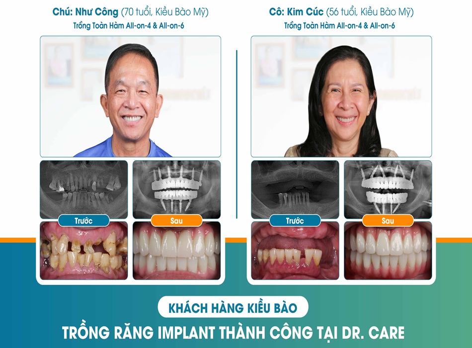 Khách hàng hài lòng khi trồng răng Implant tại Dr. Care