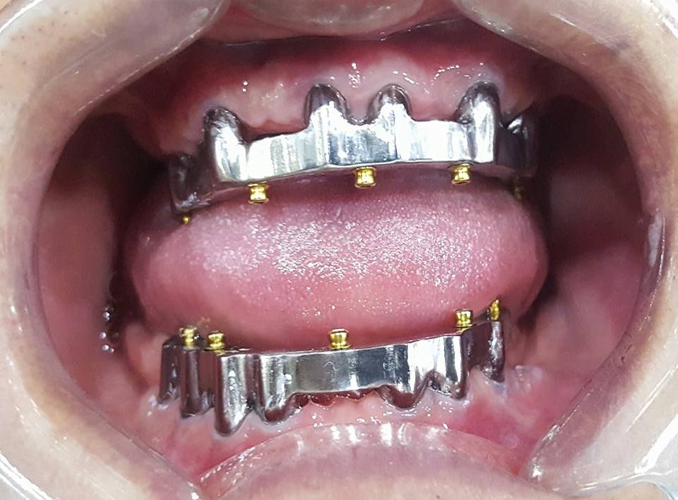 Thế mạnh về Implant và kỹ thuật nha khoa hiện đại