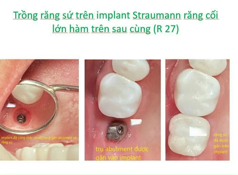 Khách hàng trồng răng sứ trên Implant Straumann tại ETRUSCA