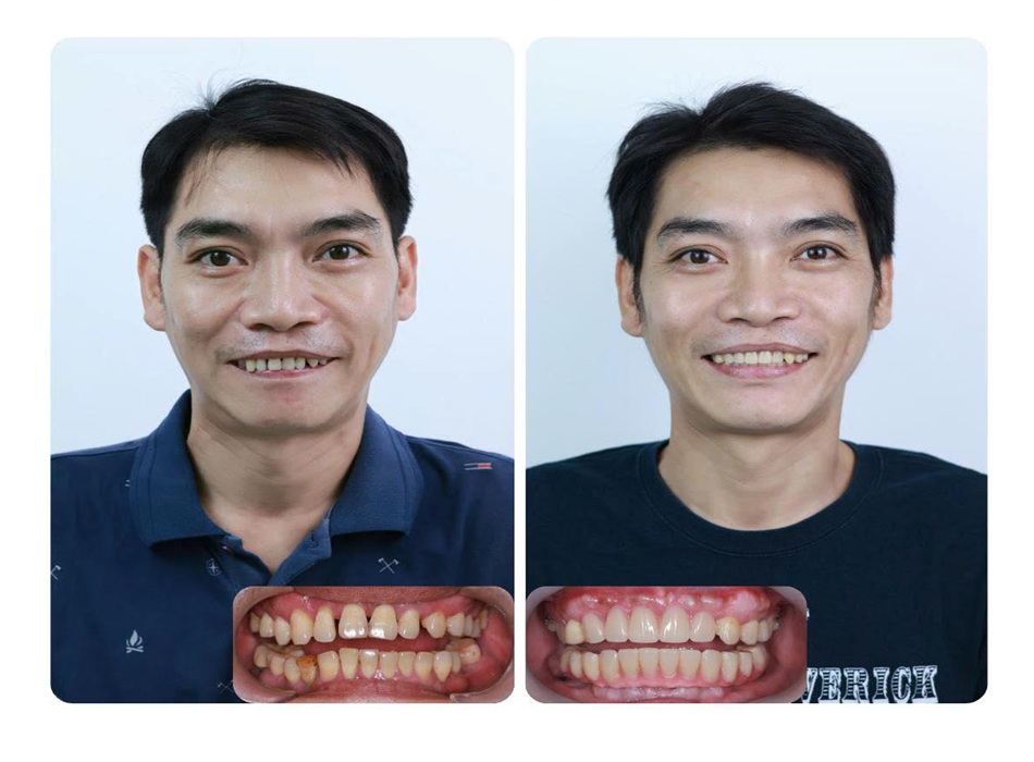 Cấy implant toàn hàm giải pháp cho bệnh nhân nha chu nặng