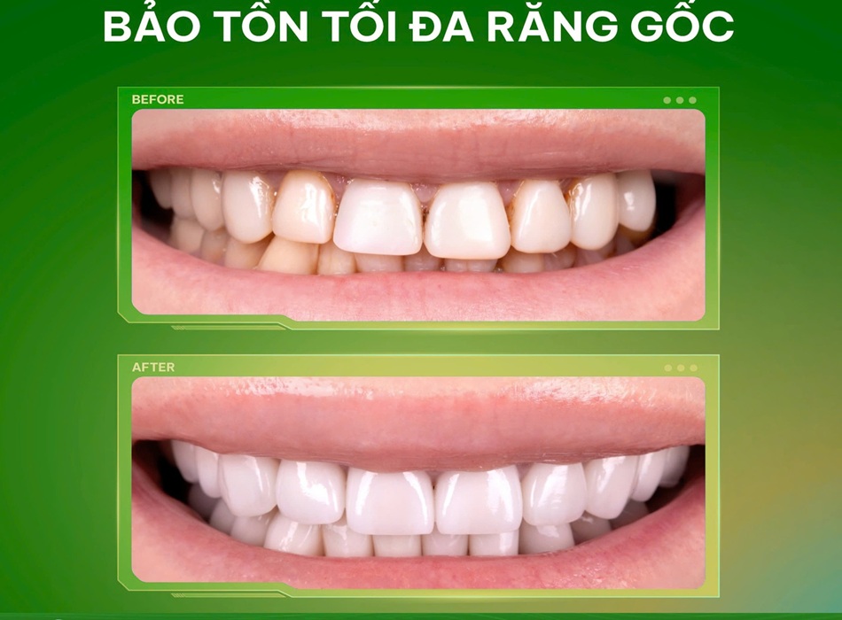 Hình ảnh trước và sau của khách hàng khi dán sứ