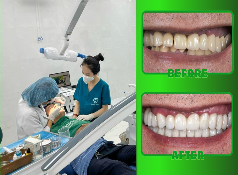 Hình ảnh khách hàng trước và sau khi sử dụng dịch vụ làm răng tại Trí Việt
