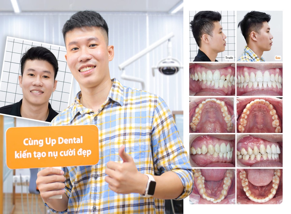 Khách hàng trước và sau khi sử dụng dịch vụ tại Up Dental