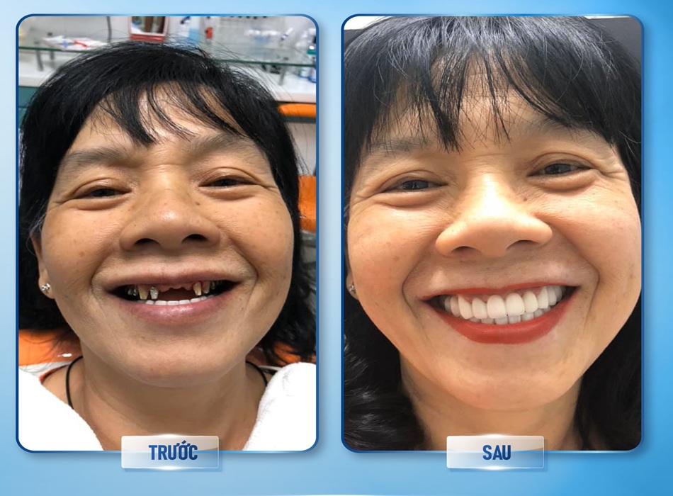 Khách hàng trước và sau khi sử dụng dịch vụ tại Nha Khoa ĐaKao