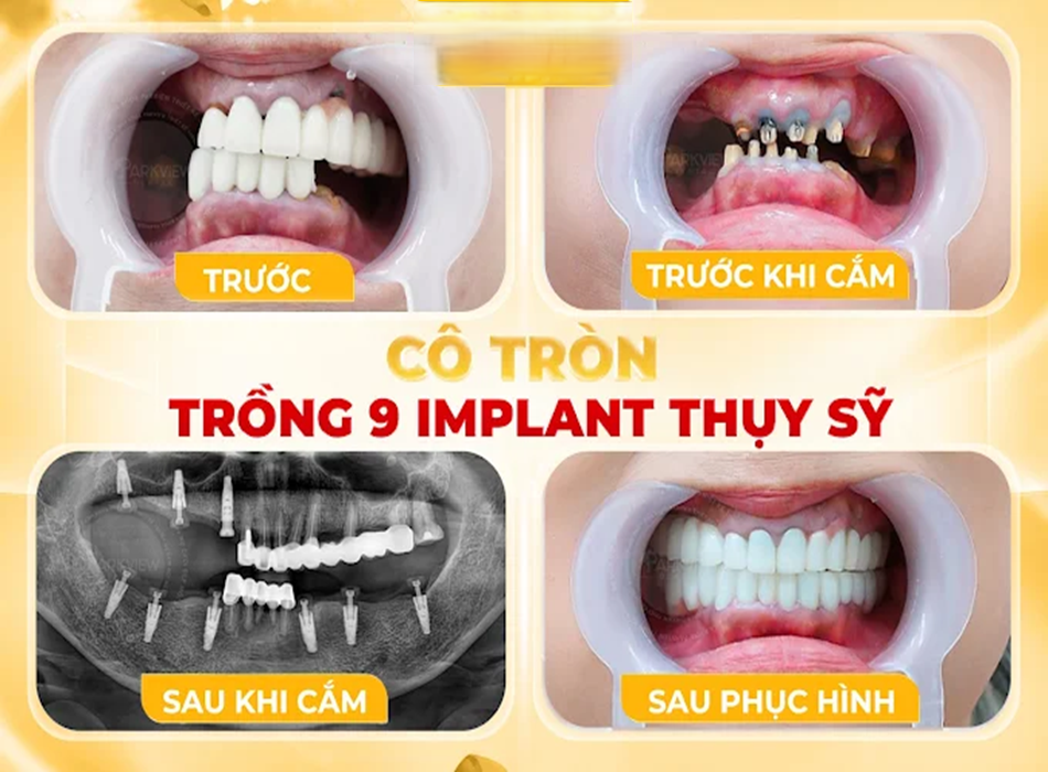 Hình ảnh trước và sau của khách hàng khi trồng Impalnt Thụy Sĩ tại Parkview Dentanl Clinic