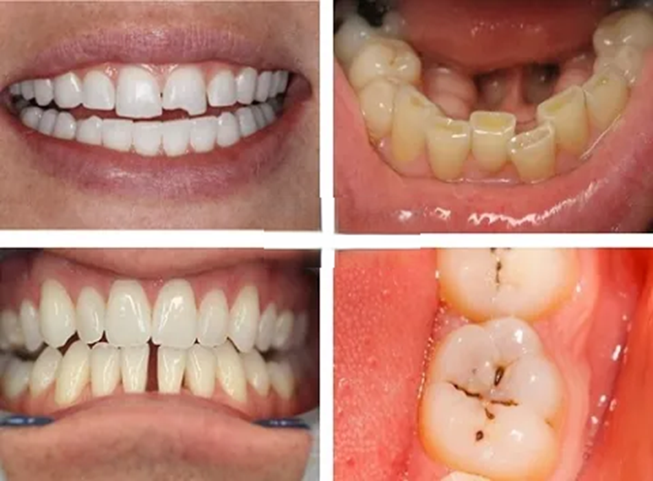 Trám răng thẩm mỹ Laser Tech tại Nha Khoa Paris