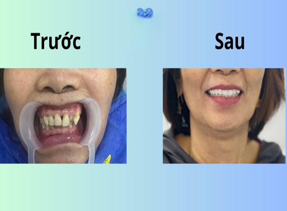 Khách hàng vô cùng hài lòng khi sử điều trị răng tại nha khoa