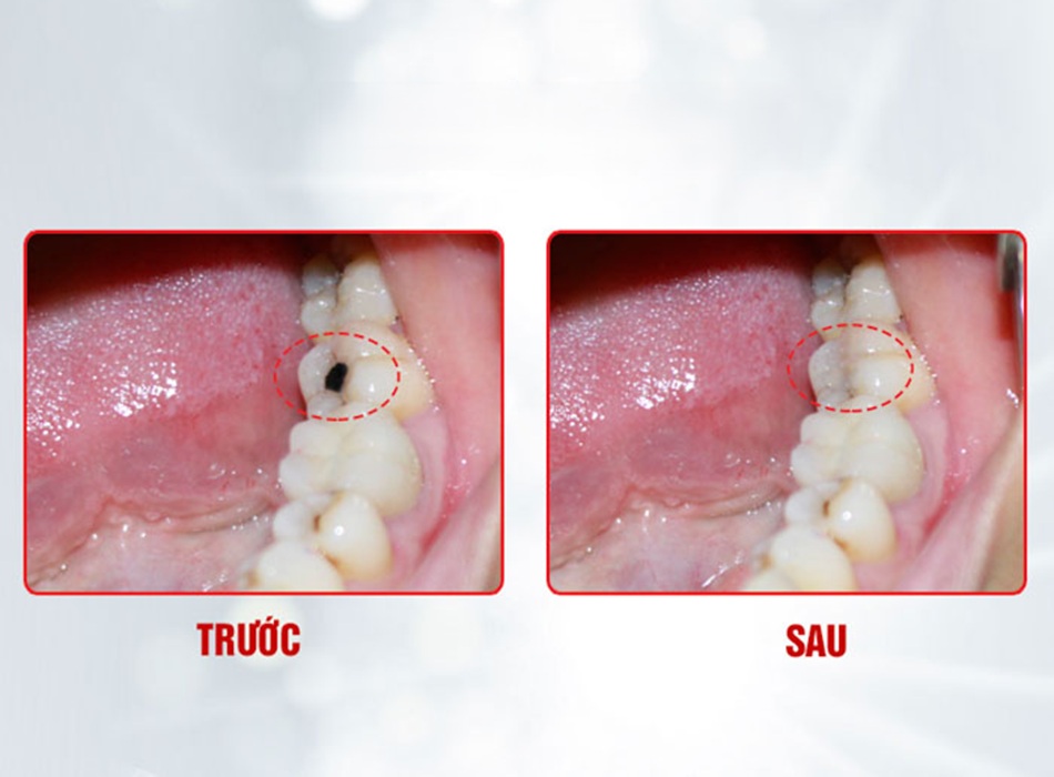 Kỹ thuật trám nhanh chóng, tinh tế