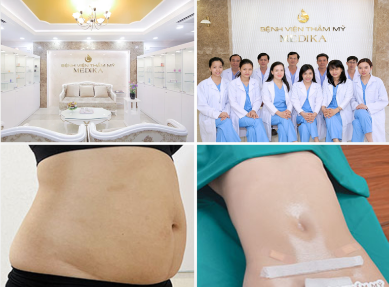Bệnh viện Thẩm mỹ Medika: Tạo hình bụng kết hợp hút mỡ 360 độ cho vòng eo tối ưu